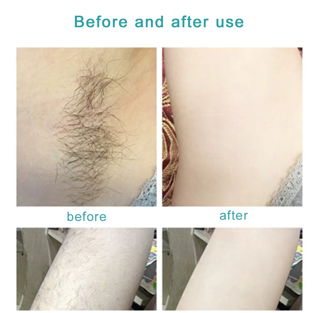Home Laser Hair Removal Device for Full Body Care
